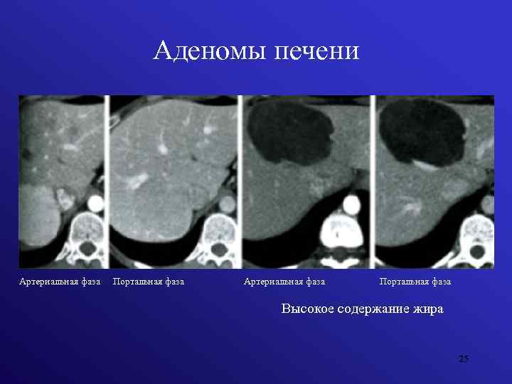 Аденомы печени Артериальная фаза Портальная фаза Высокое содержание жира 25 
