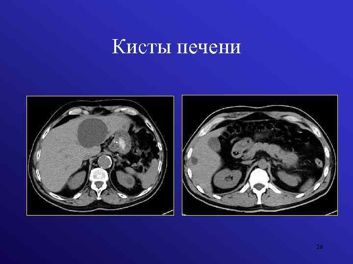 Простая киста печени при компьютерной томографии что это