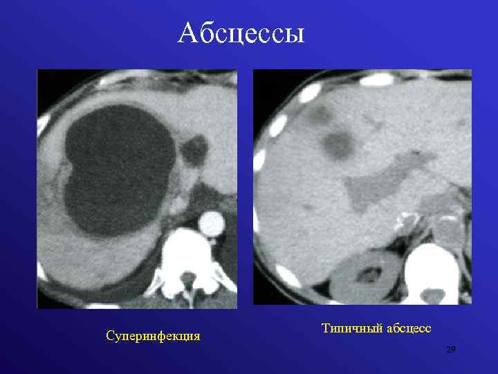 Абсцессы Суперинфекция Типичный абсцесс 29 