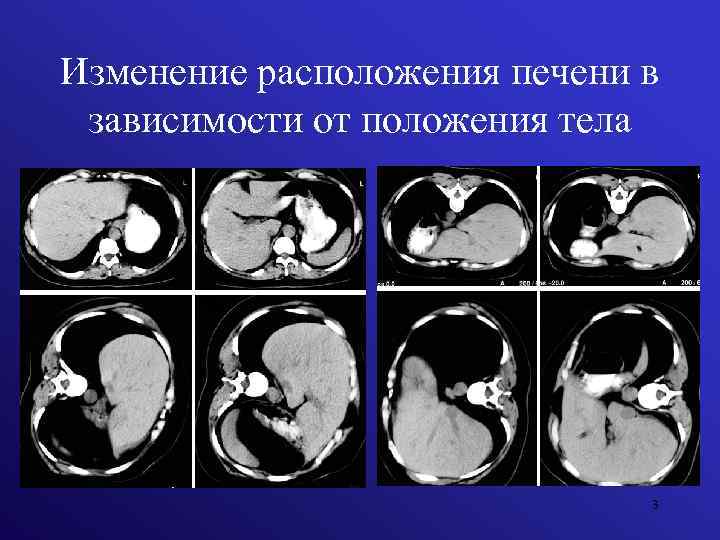 Изменение расположения печени в зависимости от положения тела 3 