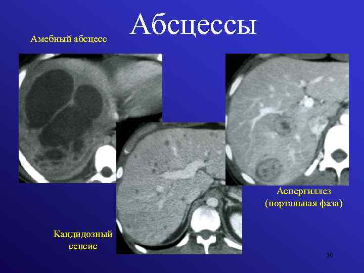 Амебный абсцесс Абсцессы Аспергиллез (портальная фаза) Кандидозный сепсис 30 