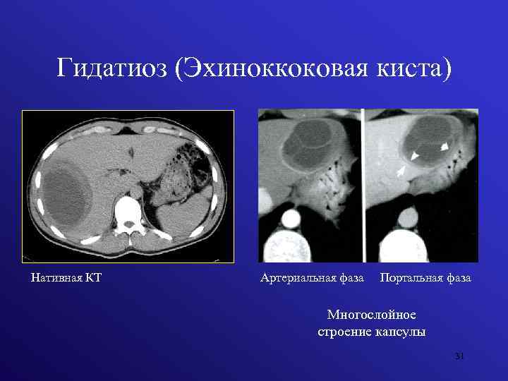 Гидатиоз (Эхиноккоковая киста) Нативная КТ Артериальная фаза Портальная фаза Многослойное строение капсулы 31 