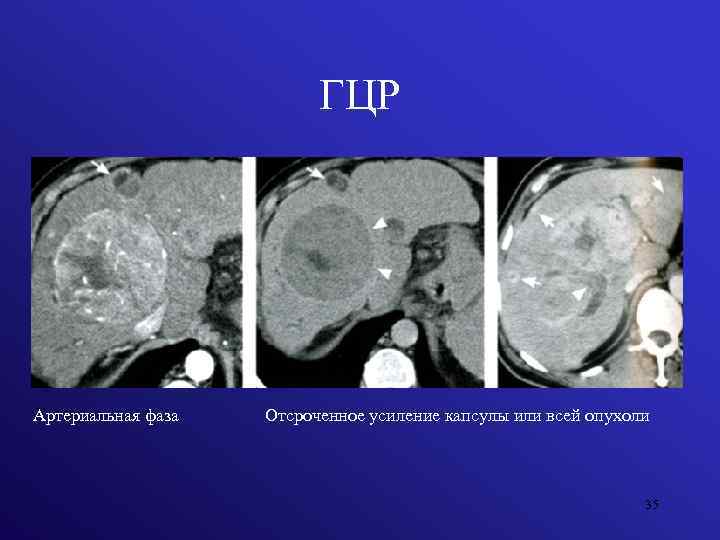 ГЦР Артериальная фаза Отсроченное усиление капсулы или всей опухоли 35 