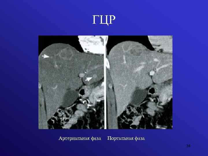 ГЦР Артериальная фаза Портальная фаза 36 