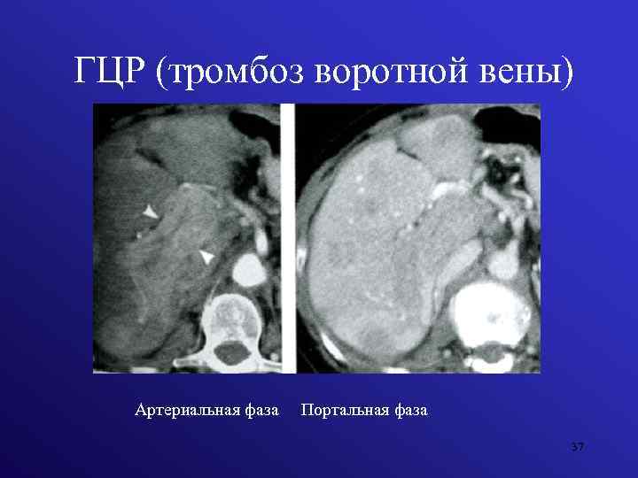 ГЦР (тромбоз воротной вены) Артериальная фаза Портальная фаза 37 