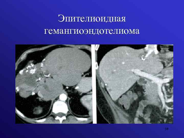 Эпителиоидная гемангиоэндотелиома 39 