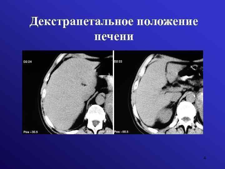 Декстрапетальное положение печени 4 