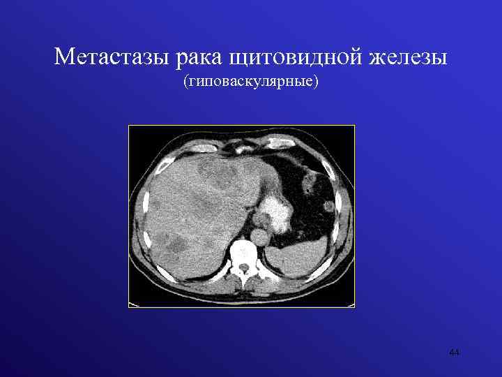 Метастазы рака щитовидной железы (гиповаскулярные) 44 