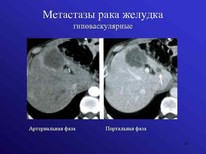 Метастазы рака желудка гиповаскулярные Артериальная фаза Портальная фаза 45 