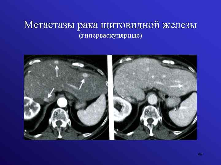 Метастазы рака щитовидной железы (гиперваскулярные) 46 