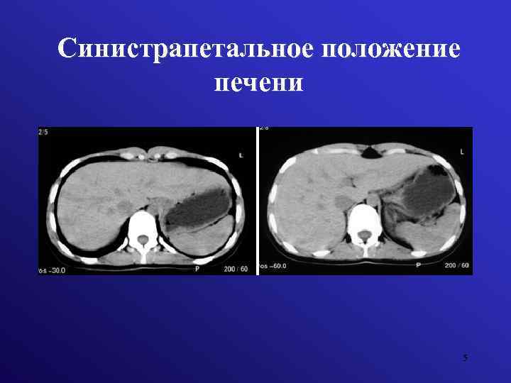 Синистрапетальное положение печени 5 