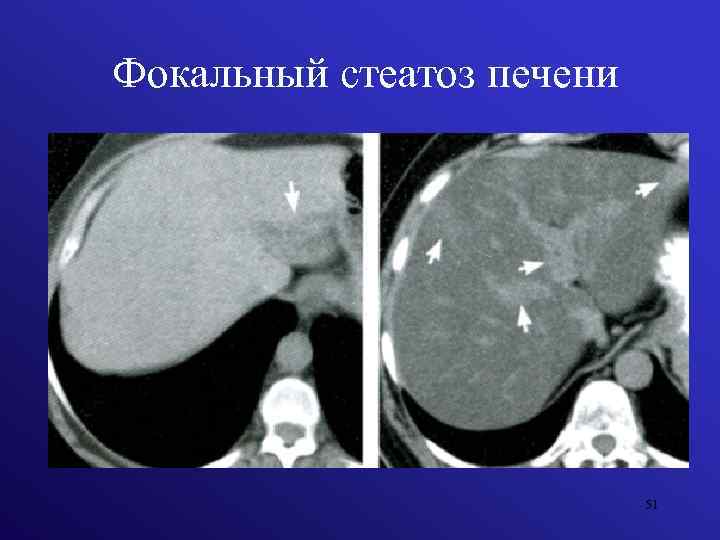 Фокальный стеатоз печени 51 