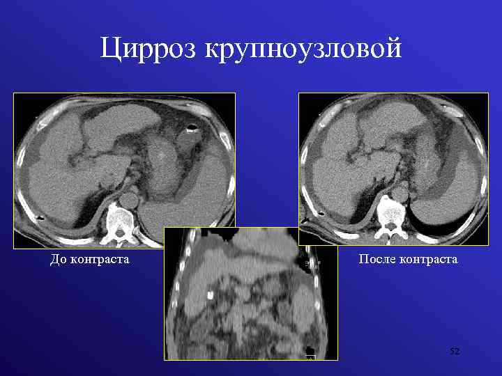 Цирроз крупноузловой До контраста После контраста 52 