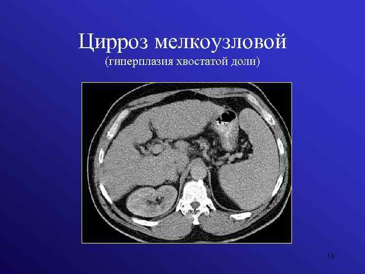 Цирроз мелкоузловой (гиперплазия хвостатой доли) 53 