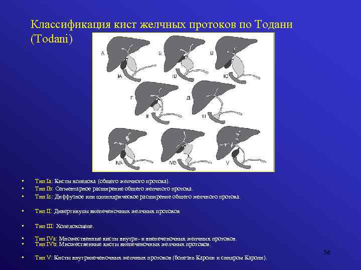 Классификация кист желчных протоков по Тодани (Todani) • • • Тип Iа: Кисты холедоха