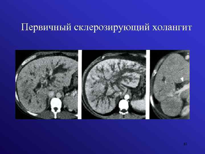 Первичный склерозирующий холангит 61 