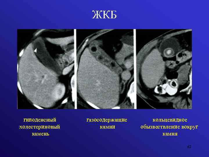 ЖКБ гиподенсный холестериновый камень газосодержащие камни кольцевидное обызвествление вокруг камня 62 