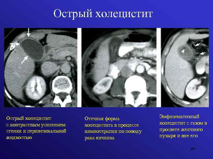 Острый холецистит с контрастным усилением стенки и перивезикальной жидкостью Отечная форма холецистита в процессе