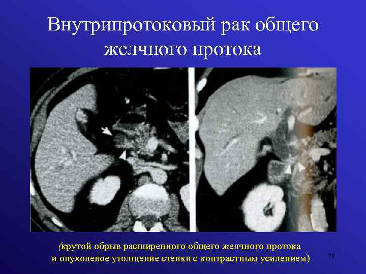 Внутрипротоковый рак общего желчного протока (крутой обрыв расширенного общего желчного протока и опухолевое утолщение