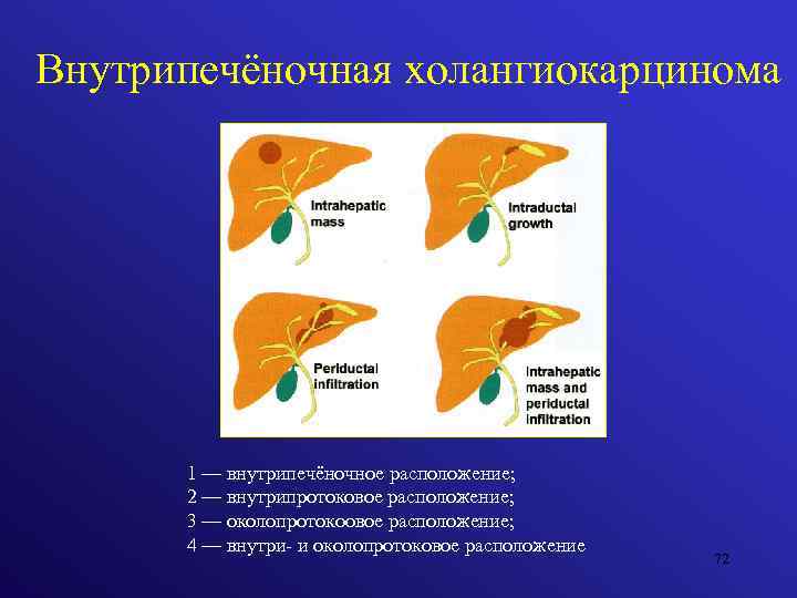 Внутрипечёночная холангиокарцинома 1 — внутрипечёночное расположение; 2 — внутрипротоковое расположение; 3 — околопротокоовое расположение;