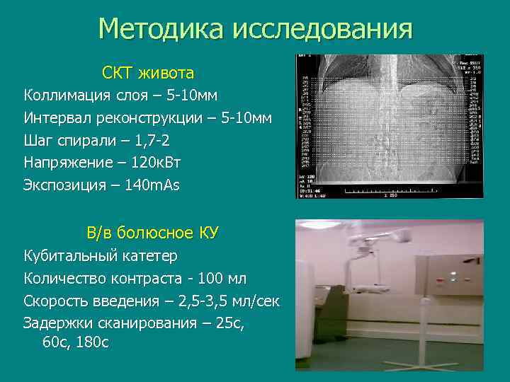 Методика исследования СКТ живота Коллимация слоя – 5 -10 мм Интервал реконструкции – 5