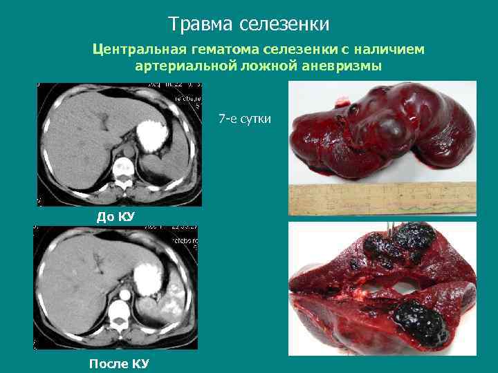 Травма селезенки Центральная гематома селезенки с наличием артериальной ложной аневризмы 7 -е сутки До