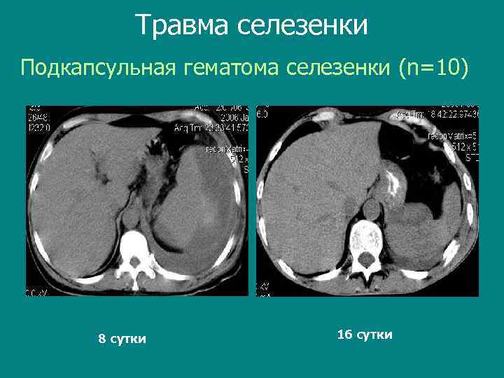 Травма селезенки Подкапсульная гематома селезенки (n=10) 8 сутки 16 сутки 