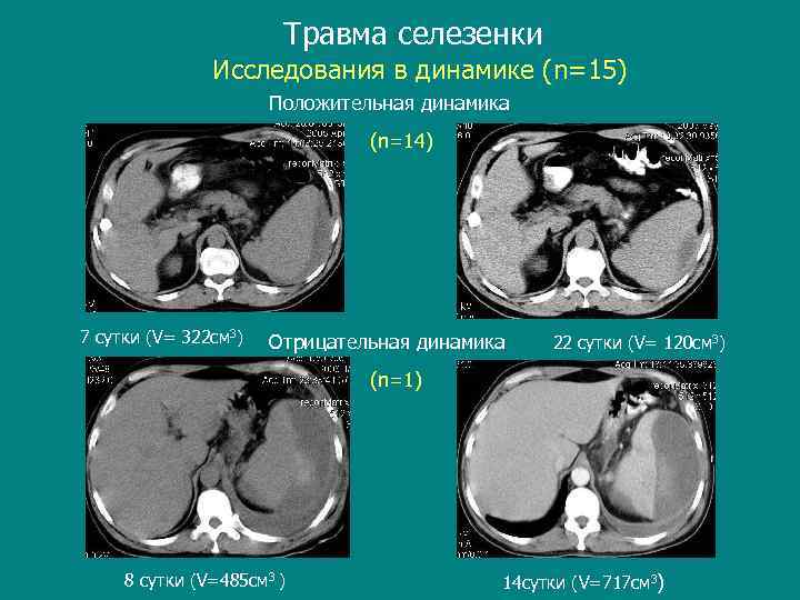 Травма селезенки Исследования в динамике (n=15) Положительная динамика (n=14) 7 сутки (V= 322 см