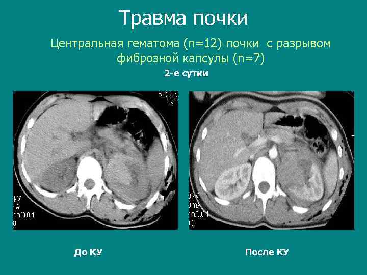 Травма почки Центральная гематома (n=12) почки c разрывом фиброзной капсулы (n=7) 2 -е сутки