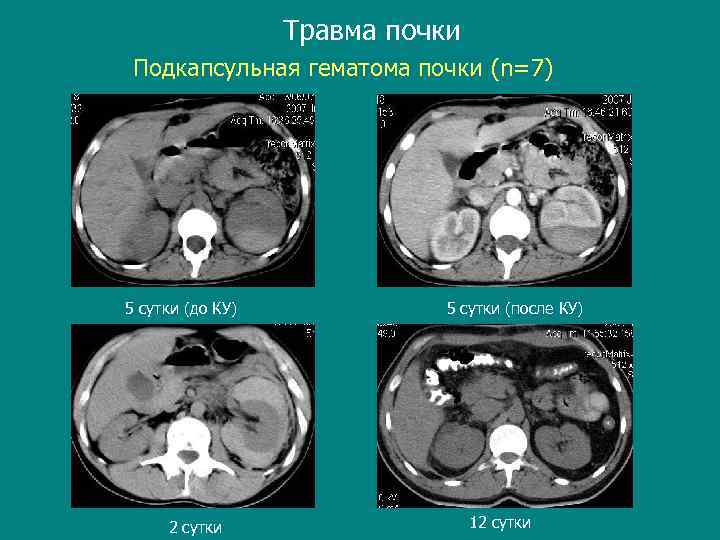 Травма почки Подкапсульная гематома почки (n=7) 5 сутки (до КУ) 2 сутки 5 сутки