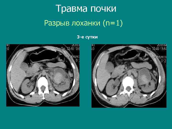 Травма почки Разрыв лоханки (n=1) 3 -е сутки 