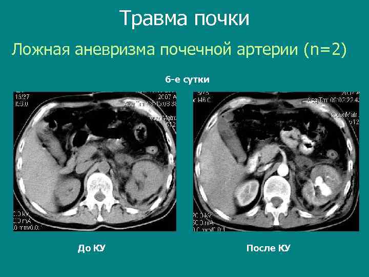 Травма почки Ложная аневризма почечной артерии (n=2) 6 -е сутки До КУ После КУ