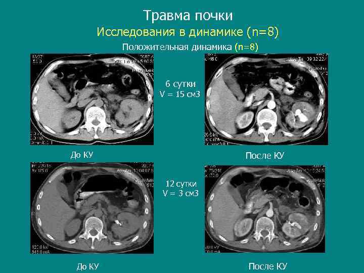 Травма почки Исследования в динамике (n=8) Положительная динамика (n=8) 6 сутки V = 15