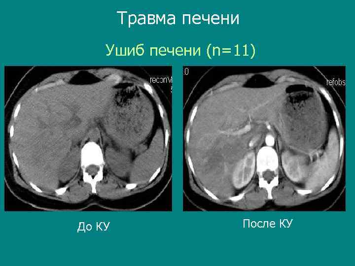 Травма печени Ушиб печени (n=11) До КУ После КУ 