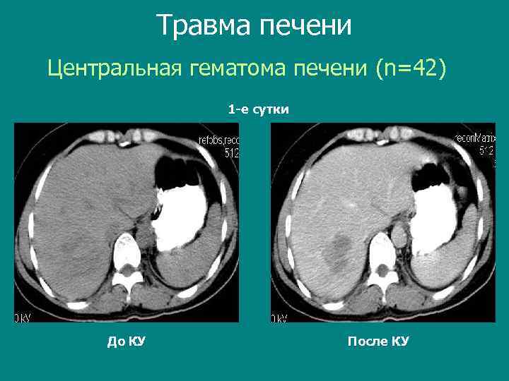 Травма печени Центральная гематома печени (n=42) 1 -е сутки До КУ После КУ 