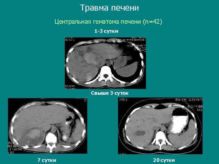 Травма печени Центральная гематома печени (n=42) 1 -3 сутки Свыше 3 суток 7 сутки