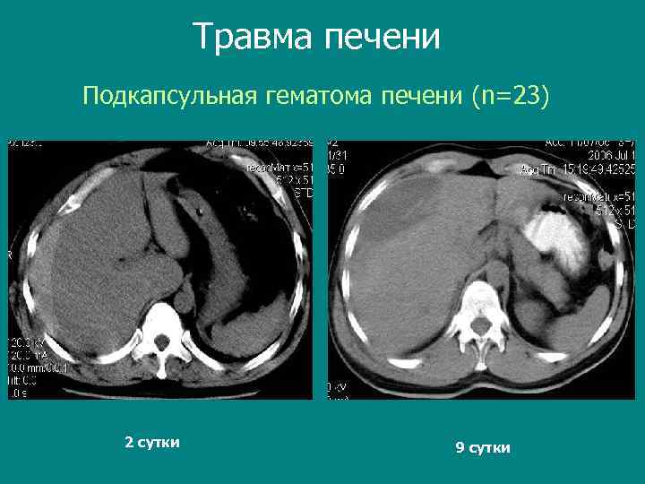 Травма печени Подкапсульная гематома печени (n=23) 2 сутки 9 сутки 