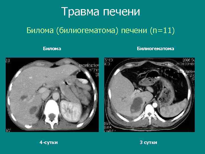 Травма печени Билома (билиогематома) печени (n=11) Билома 4 -сутки Билиогематома 3 сутки 