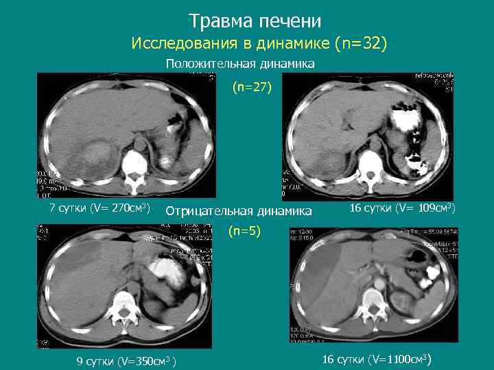 Травма печени Исследования в динамике (n=32) Положительная динамика (n=27) 7 сутки (V= 270 см