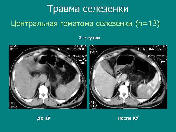 Травма селезенки Центральная гематома селезенки (n=13) 2 -е сутки До КУ После КУ 