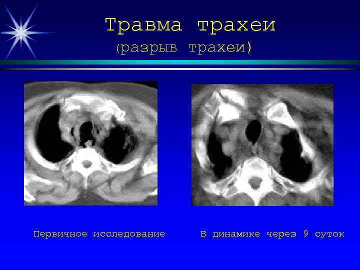 Травма трахеи (разрыв Первичное исследование трахеи) В динамике через 9 суток 