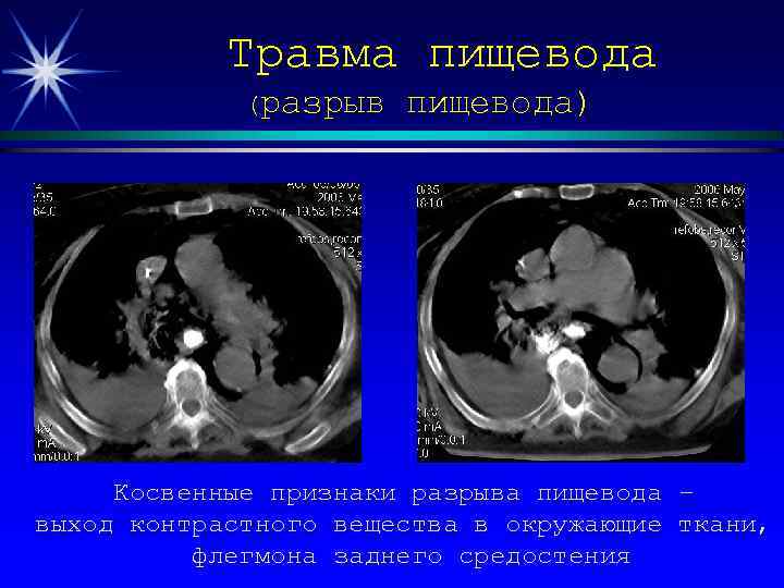 Травма пищевода (разрыв пищевода) Косвенные признаки разрыва пищевода выход контрастного вещества в окружающие флегмона