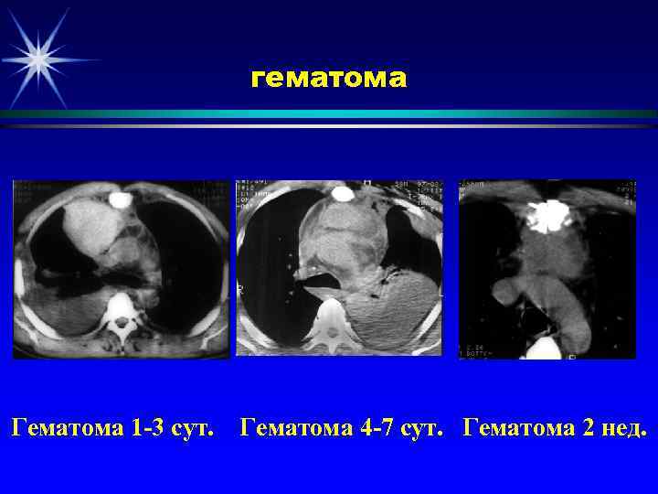 гематома Гематома 1 -3 сут. Гематома 4 -7 сут. Гематома 2 нед. 