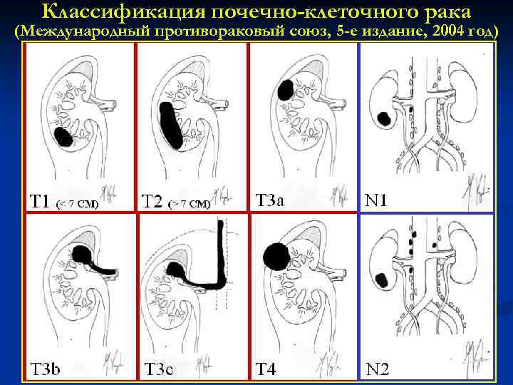 Классификация почечно-клеточного рака (Международный противораковый союз, 5 -е издание, 2004 год) Radiology Institute University