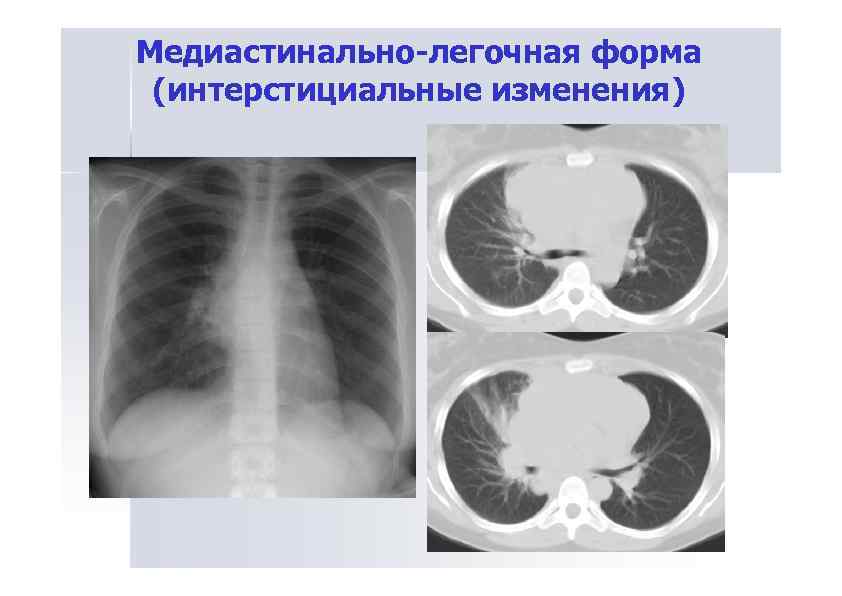 Что означает в заключении рентгенолога: корни легких расширены