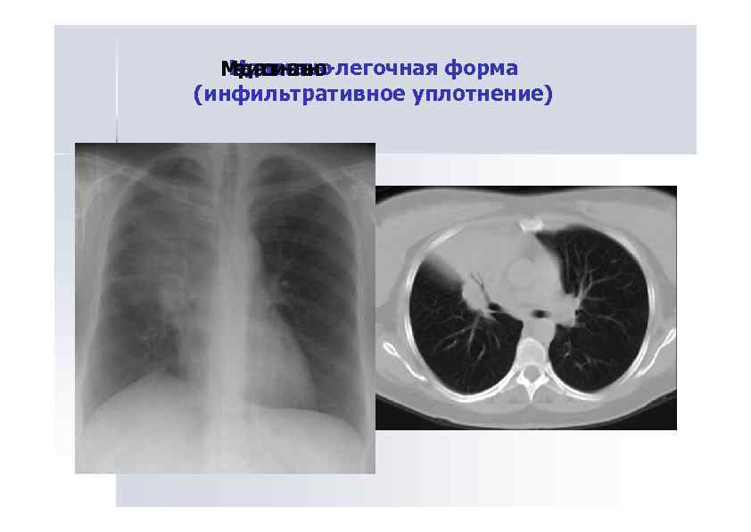 Мд аинл о Ме исиаьн-легочная форма еи стнль о д ат а н (инфильтративное