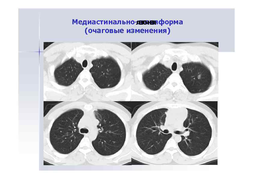 Медиастинально-лгоняформа ле ч а ег ч а он я (очаговые изменения) 