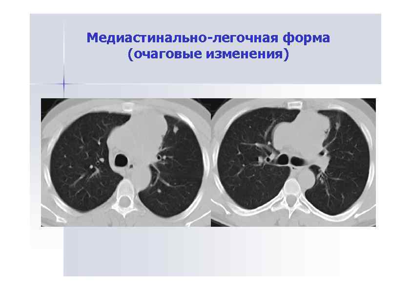 Медиастинально-легочная форма (очаговые изменения) 