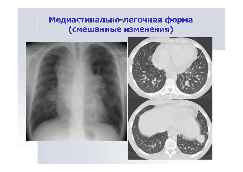 Медиастинально-легочная форма (смешанные изменения) 