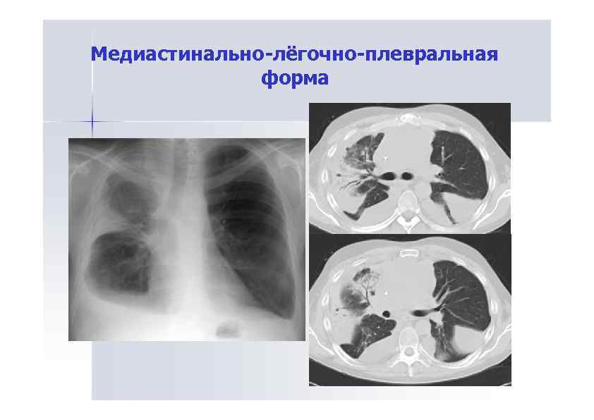 Лимфаденопатия средостения легких что это такое